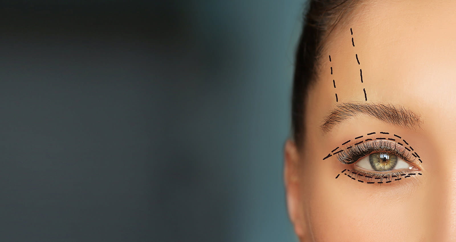 Perforation lines on females face in preparation for lower and upper blepharoplasty