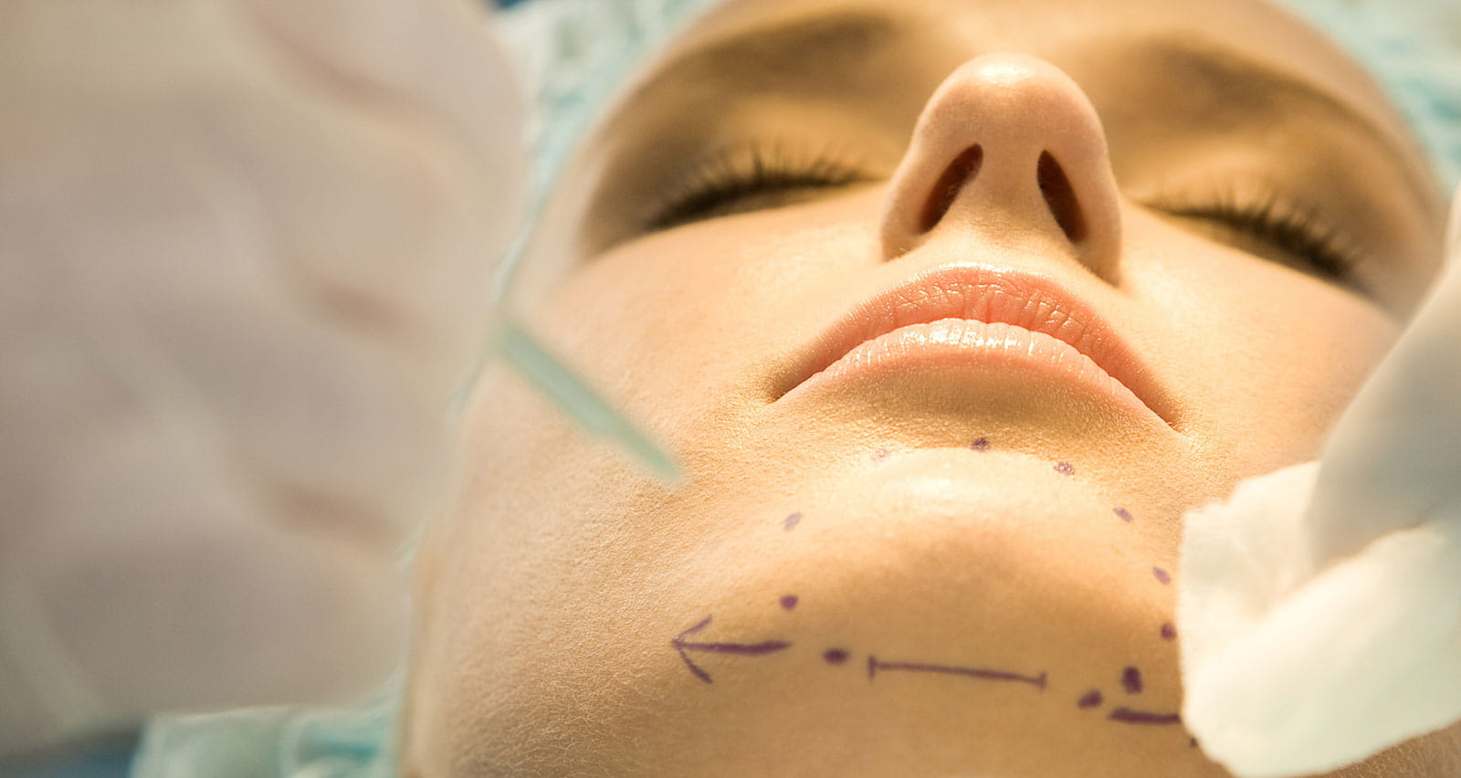Close-up of patient’s chin with marks before operation