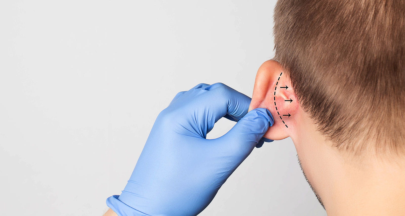 A plastic surgeon examines a male patient's ear for an otoplasty operation