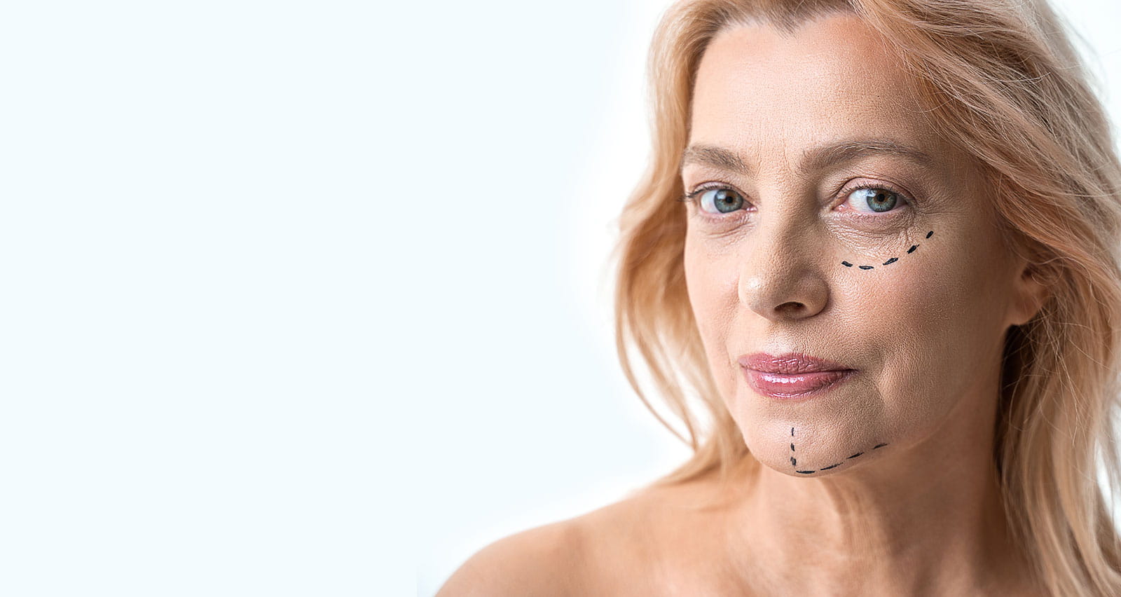 Portrait view of mature female patient looking at the camera before facelift surgery