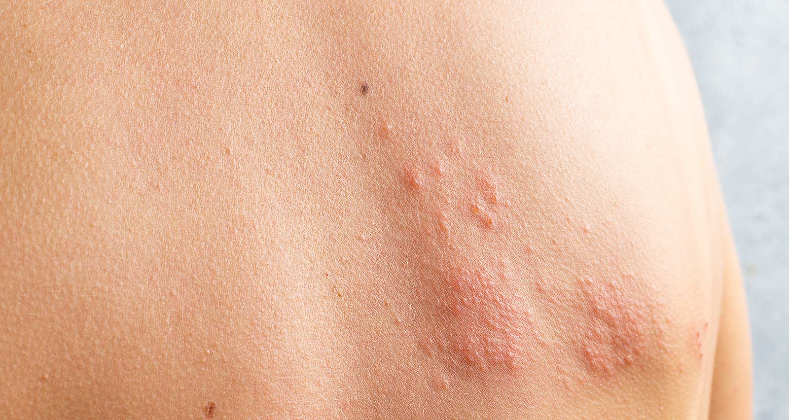 Skin infected with the Herpes zoster virus
