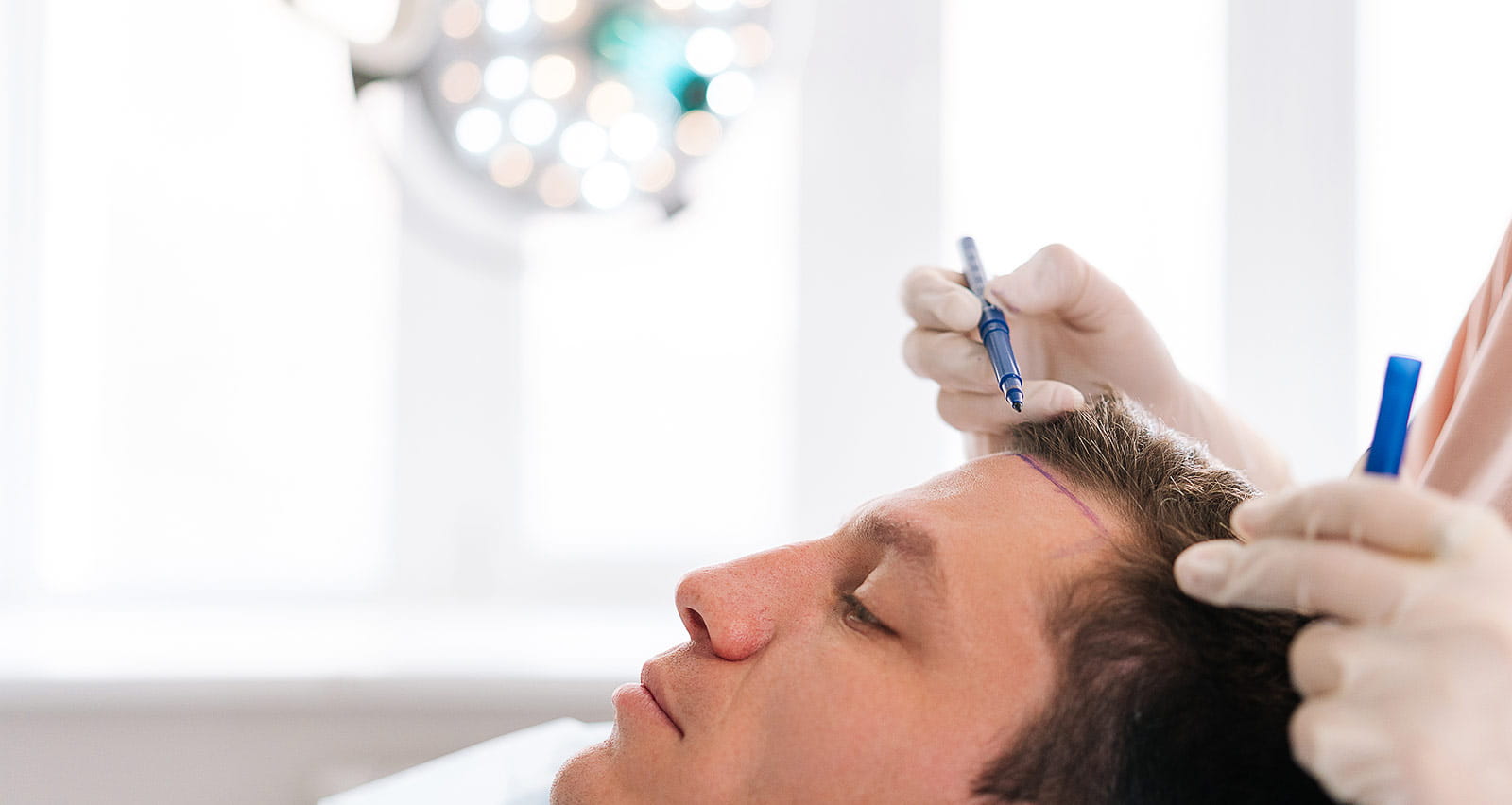 A female nurse drawing new hairline on head of male patient before hairline advancement surgery