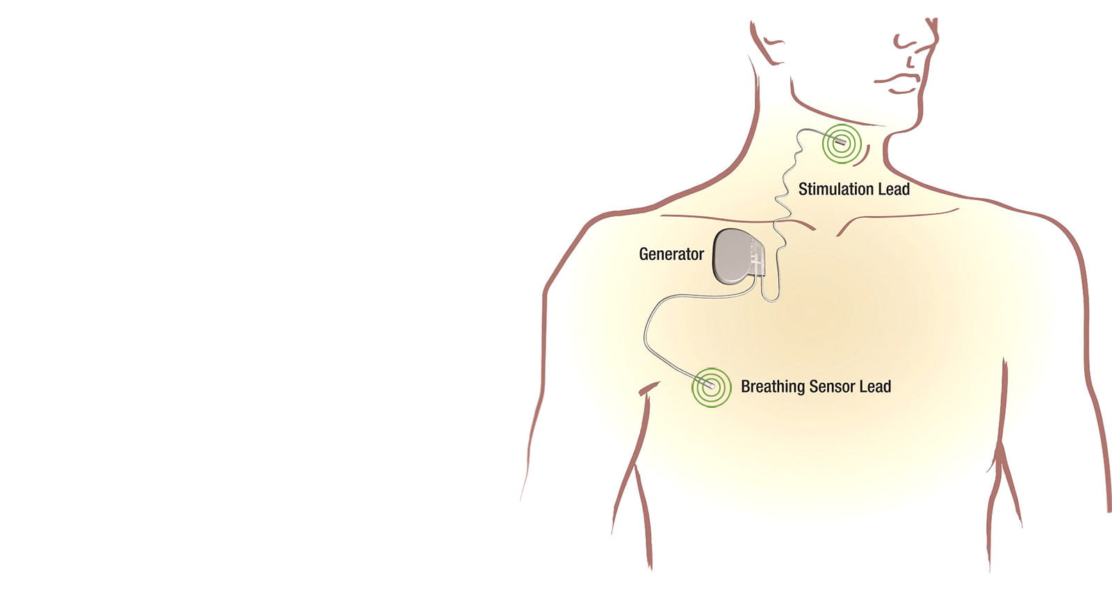 Medical Illustration demonstrating how Inspire Therapy works