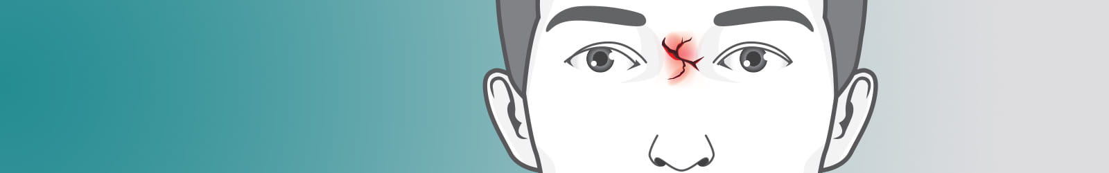 Illustration of nasal fracture on man's face