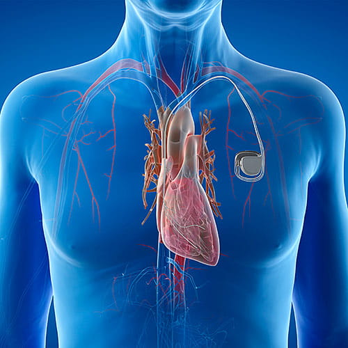 Illustration of a man with a pacemaker