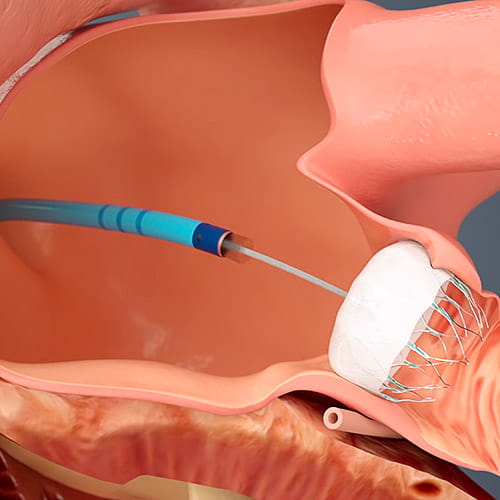 Illustration of the WATCHMAN device