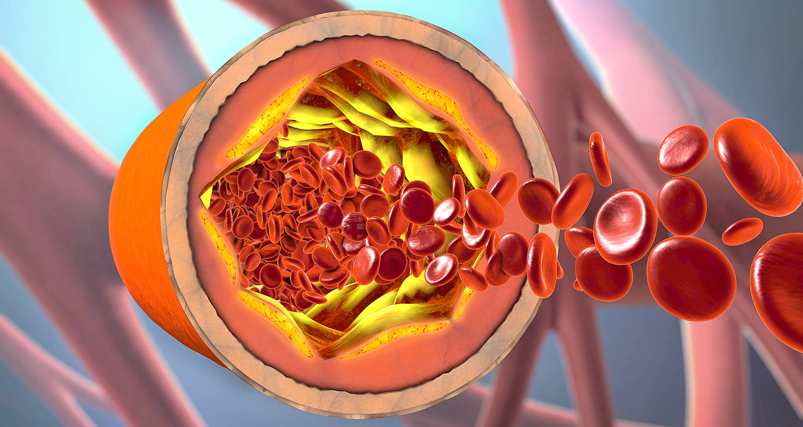 3d illustration of a precipitated and narrowing blood vessels or arteriosclerosis
