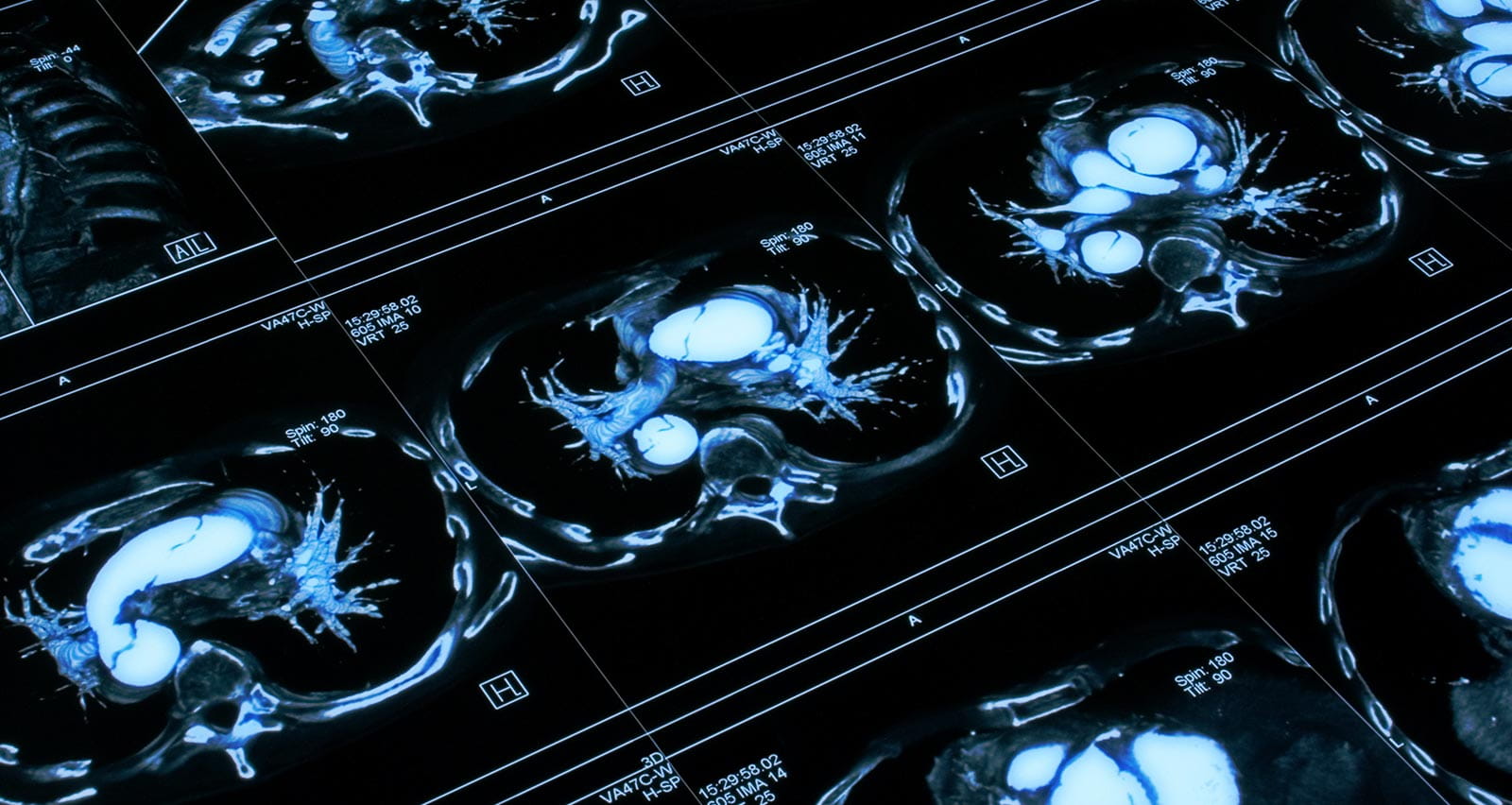 X-ray images of the heart