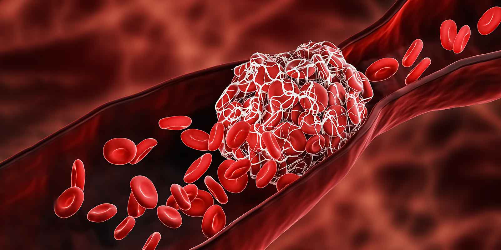Illustration of a blood clot or thrombus blocking the red blood cells stream within an artery or a vein
