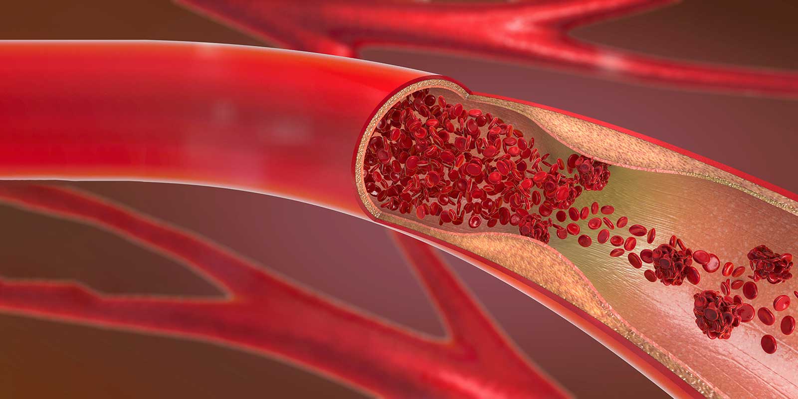 Illustration of Arteriosclerosis
