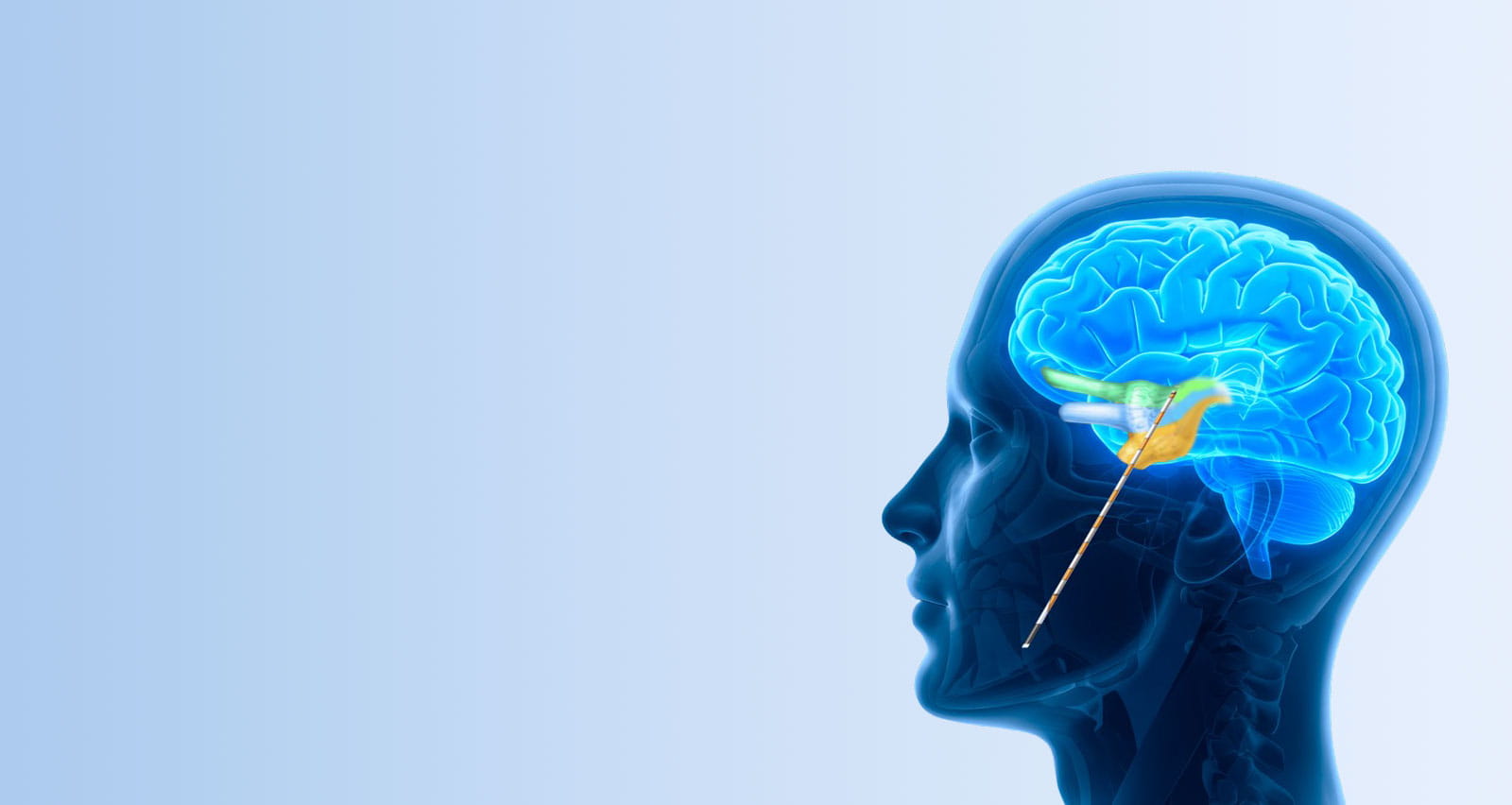 Illustration of a brain with the OneRF® Trigeminal Nerve Ablation System in place