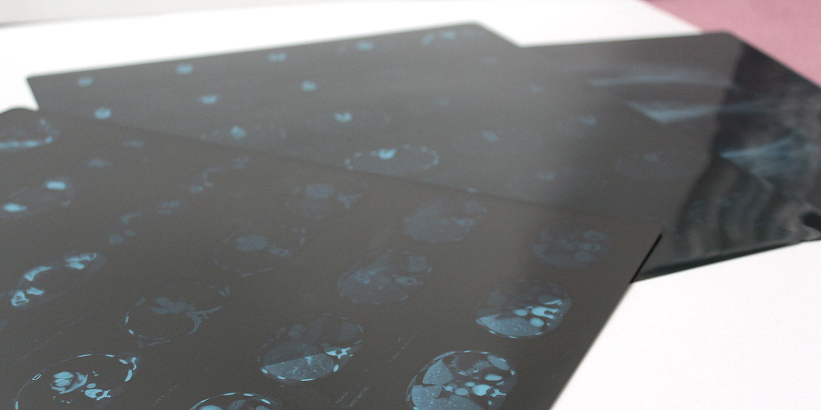 Mammogram Tomosynthesis screening result