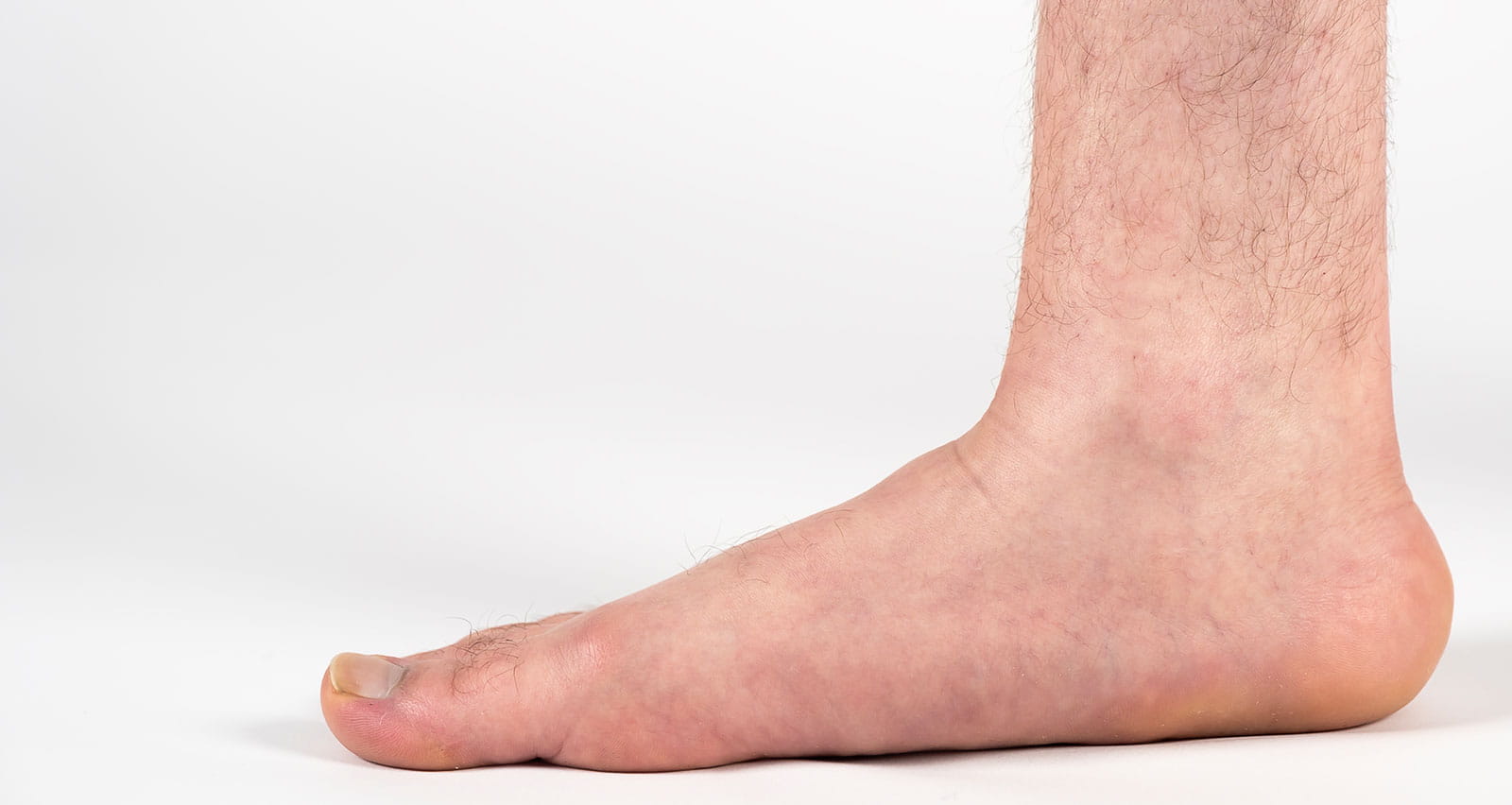 Close-up of a foot displaying symptoms of pes planus or fallen arches