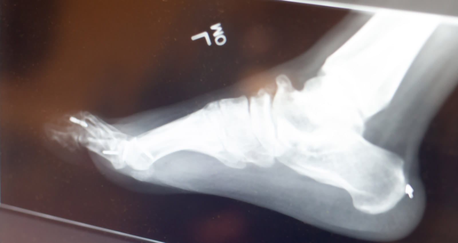 X-ray image of a foot