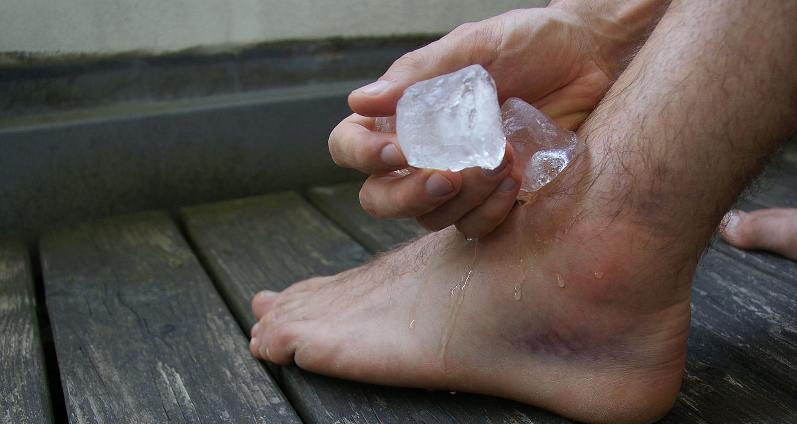 A man cools his swollen ankle with ice cubes after suffering a ligament strain or rupture after a supination trauma