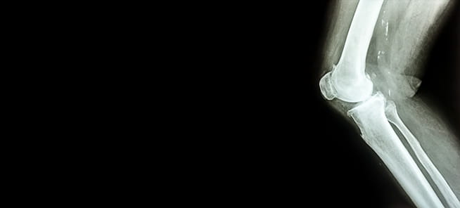 X-ray image of bent knee