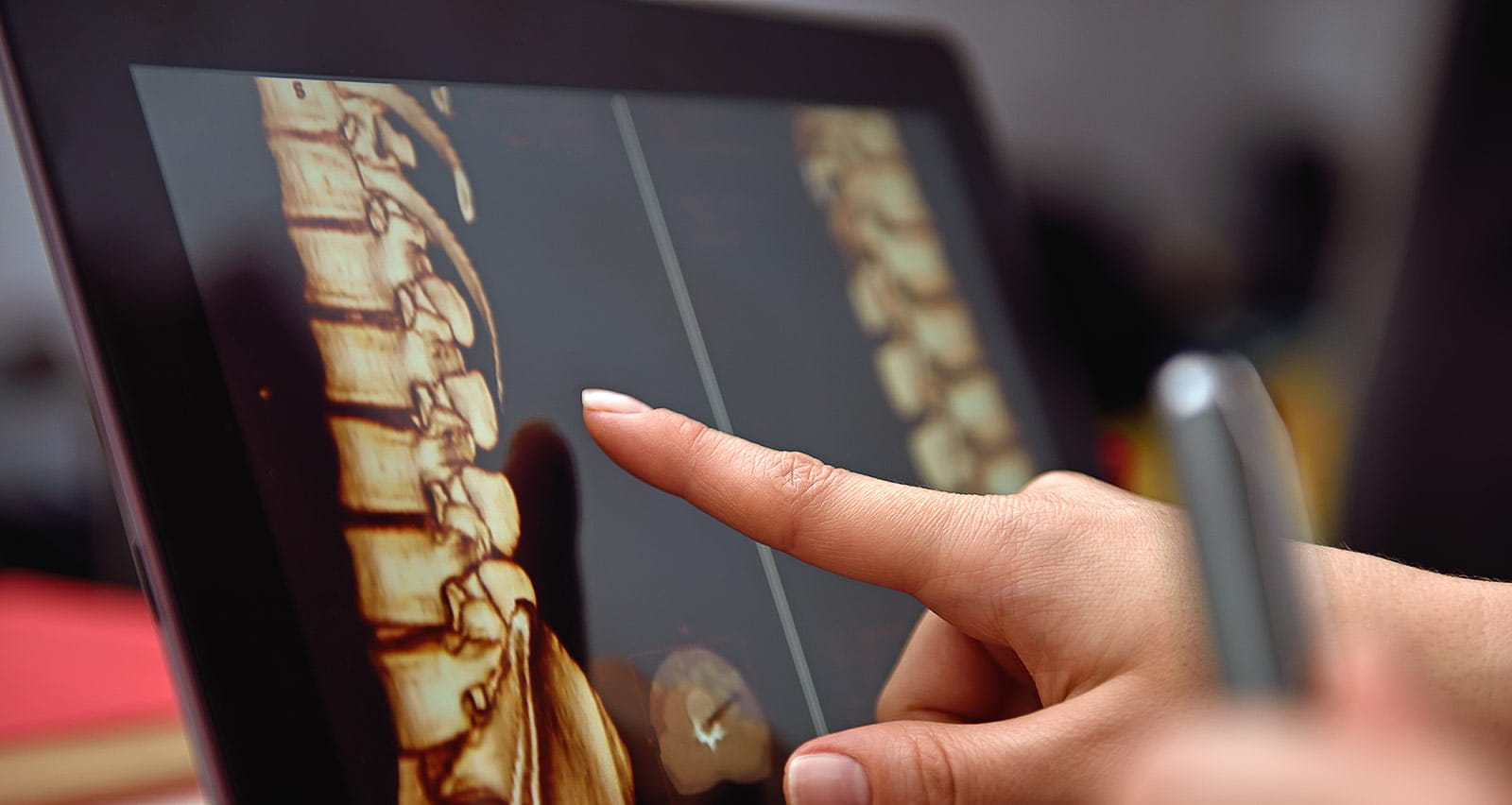Hand pointing on screen with X-rays of the spine