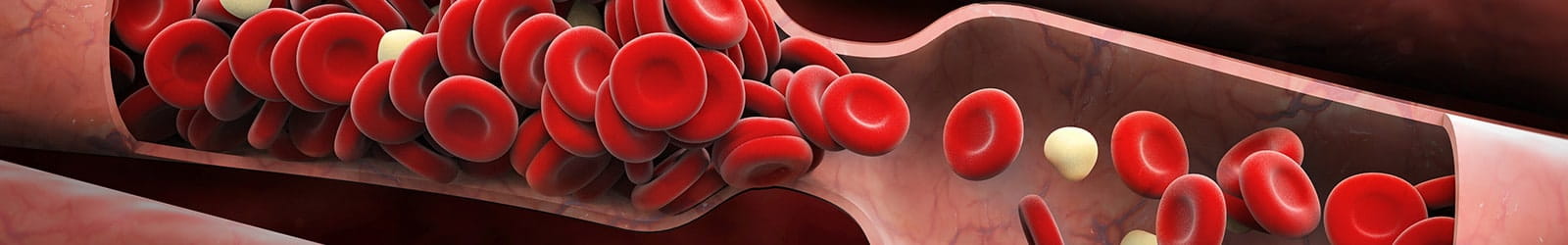 Medical illustration of a blood clot.