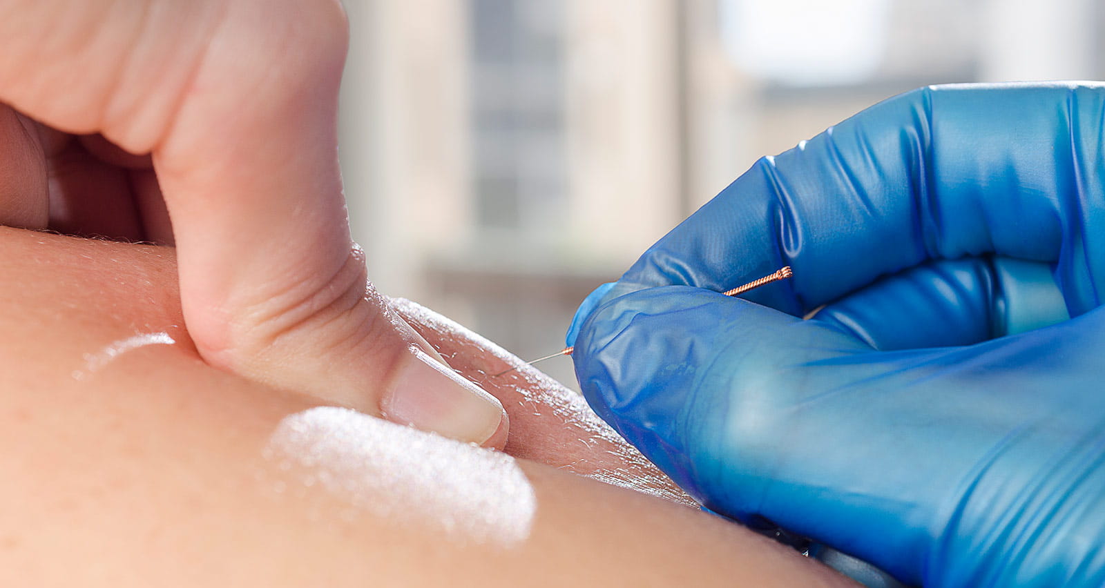 Closeup of a needle and hands of physiotherapist doing a dry needling