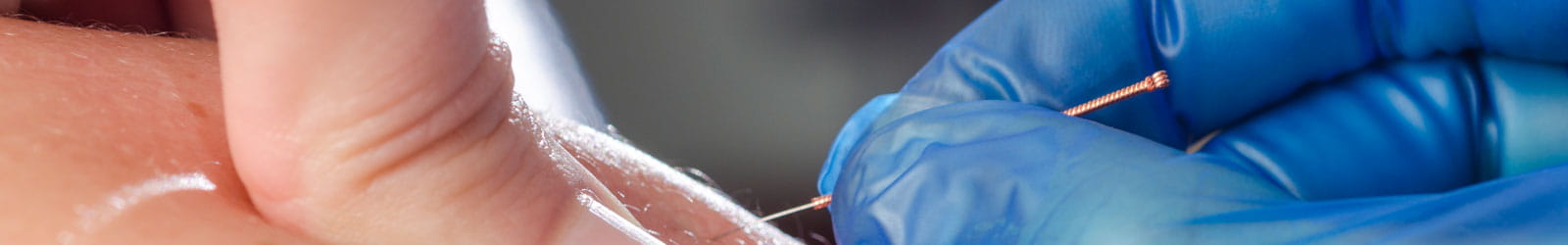 Needle and hands of physiotherapist doing a dry needling