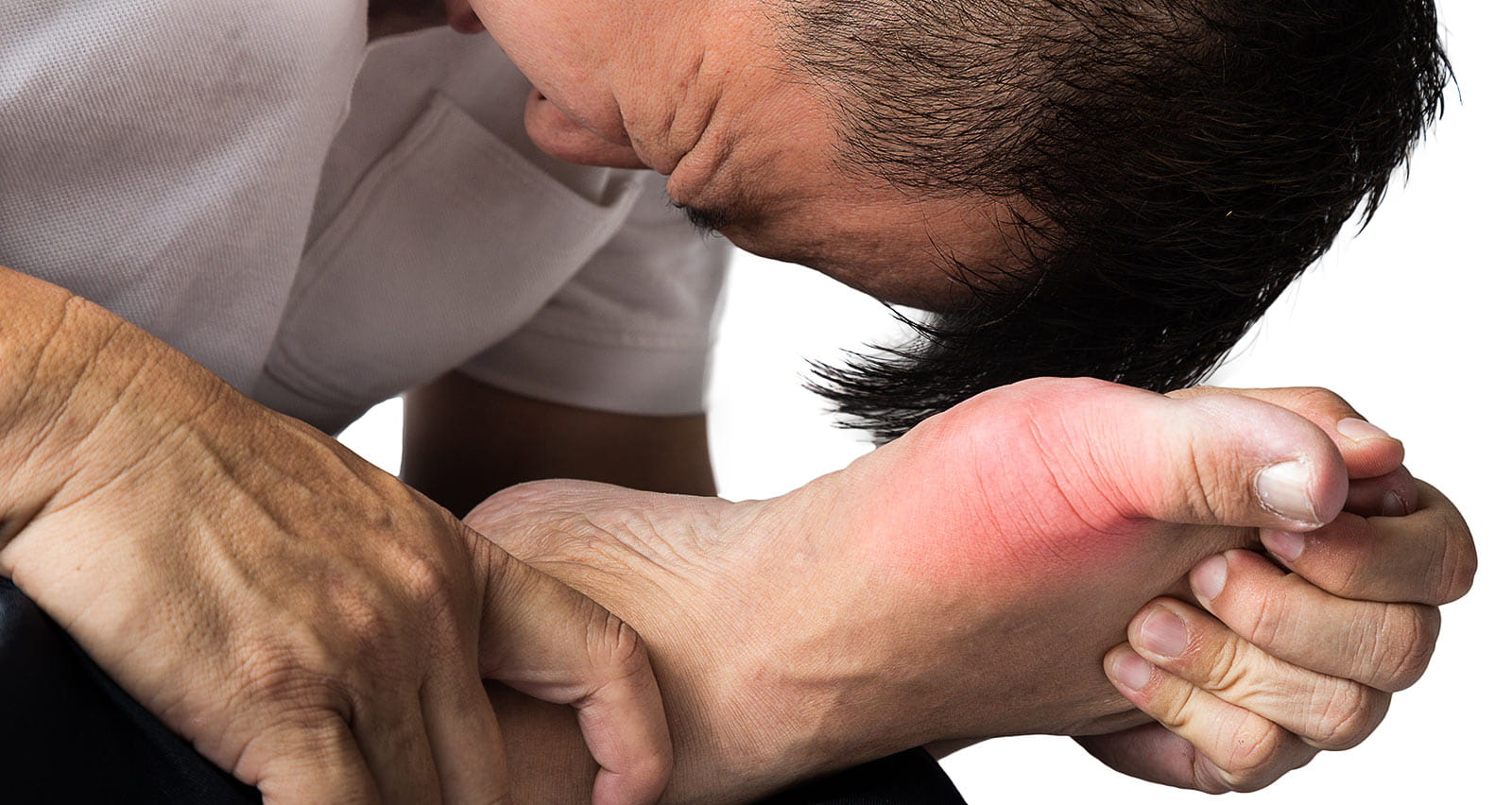 A man suffering from painful and inflamed gout on his right foot around the big toe area