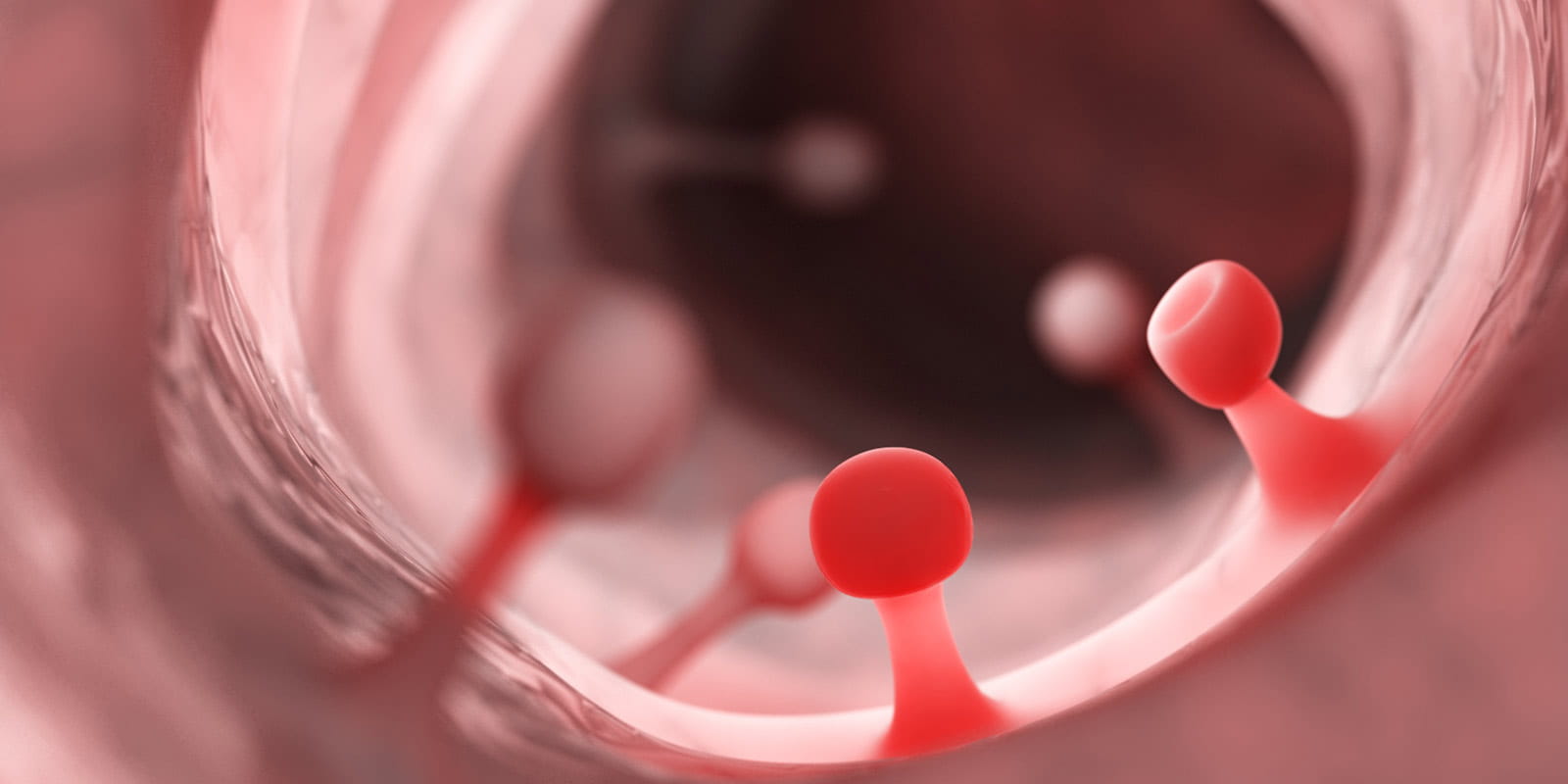 Illustration of colon polyps