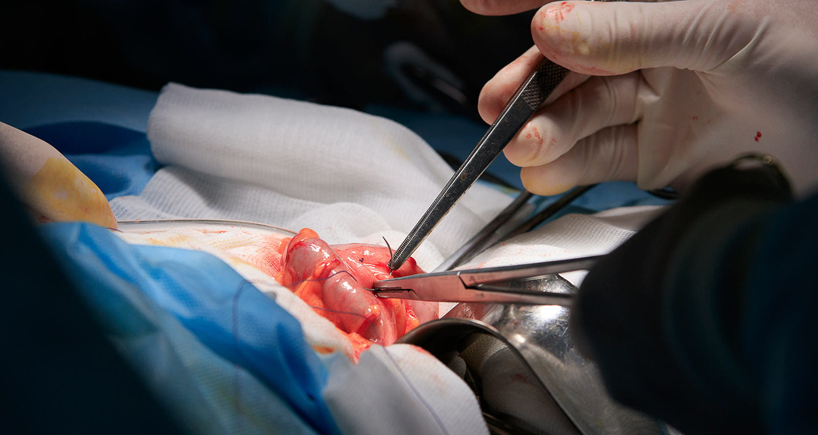 Close-up of surgeon sewing the stoma with surgical needle and instruments