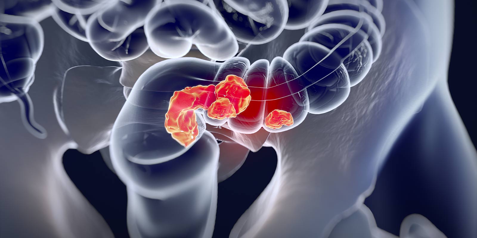 Medical Illustration of obstruction in colon.